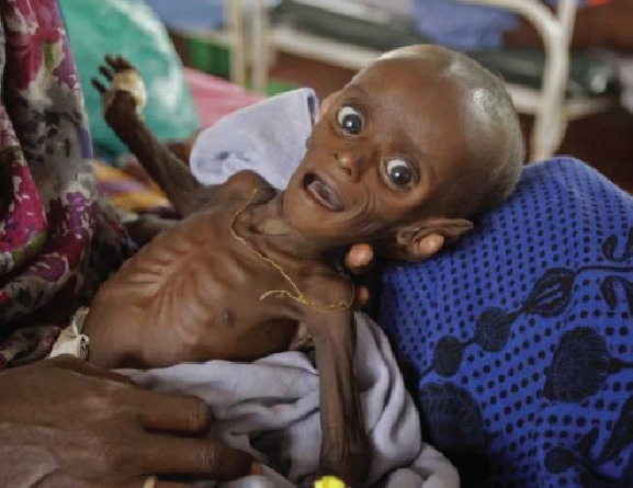 Somalia Children Starve to Death